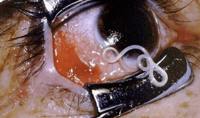 Types of parasites in human body